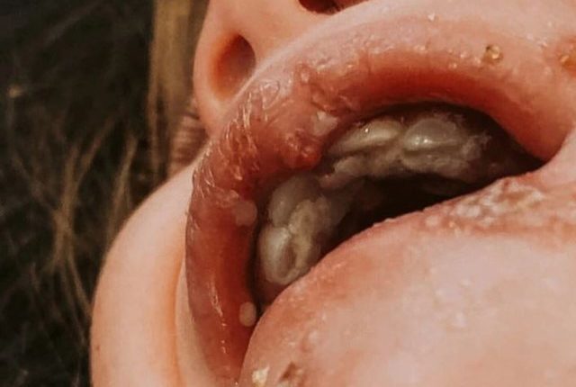 Kujdes! Kjo foto tregon pse nuk duhet ti lini të tjerët të puthin fëmijën tuaj