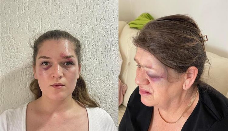Nënë e bijë rrihen brutalisht nga fqinji i tyre në Shkup (FOTO)