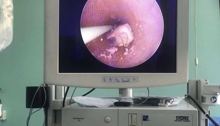 Në Spitalin e Gostivarit bëhet thyerja e gurit në kanal urinar me Holmium laserit