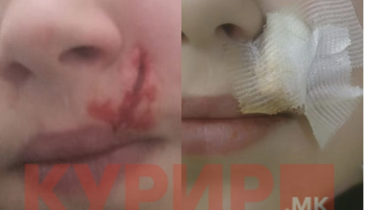 Dramë në një shkollë fillore të Shkupit: Nxënësi rrihet keq nga shoku i klasës, i çahet pjesa mbi buzë