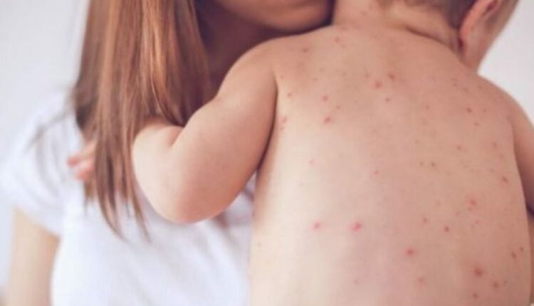 Do të vërtetohen personat e pavaksinuar nga fruthi dhe do të thirren për vaksinim në fshatin Konjare e Poshtme