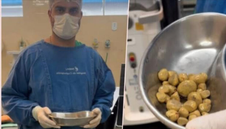 Rasti tronditës nga Brazili: Mjeku heq 35 gurë nga një pacient që pinte 3 litra pije të gazuara në ditë