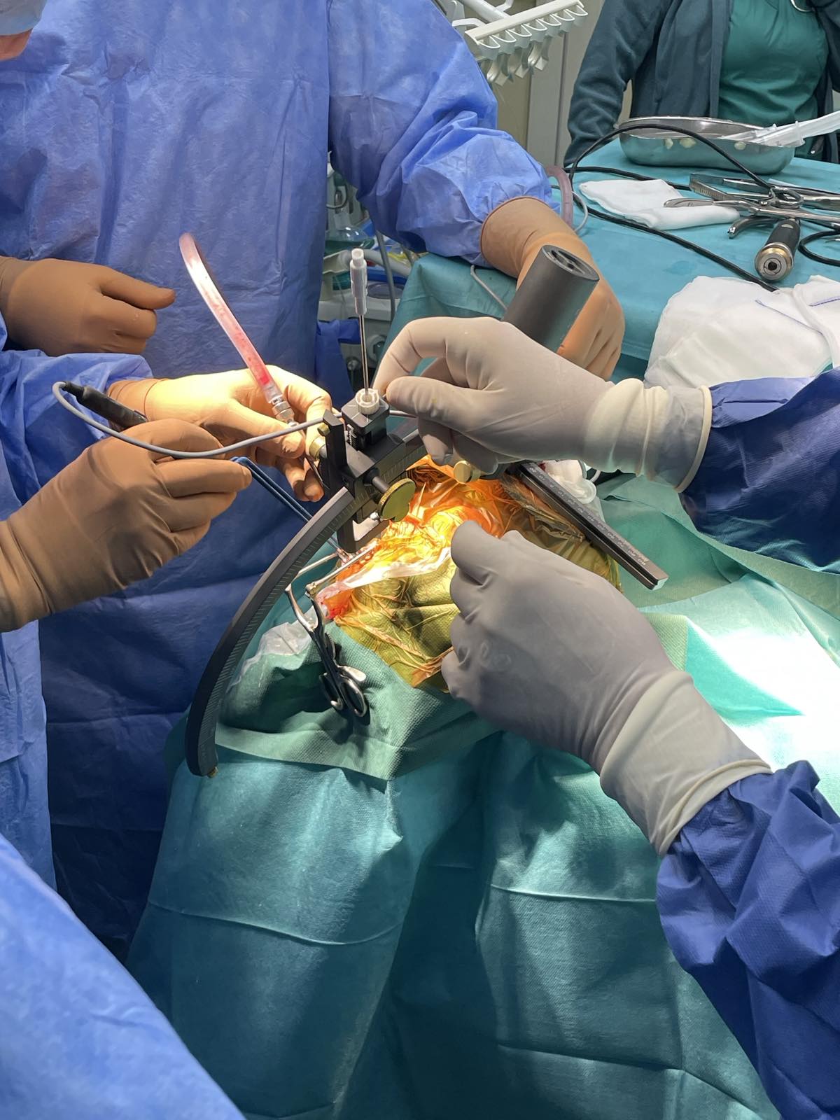 Aliu – Agai: Në Klinikën e Neurokirurgjisë në Shkup për herë të parë u krye një operacion në tru me ndihmën e sistemit të stereotaksisë