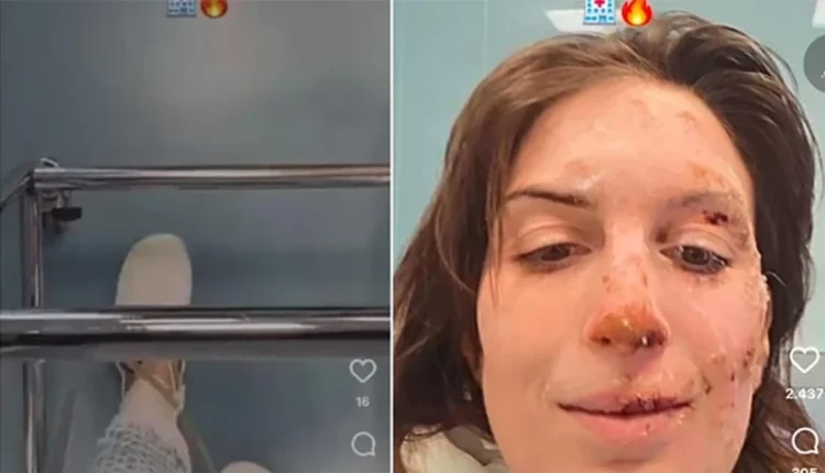 Rrëfimi i gruas që i mbijetoi zjarrit në Zvicër: Nuk e di si shpëtova