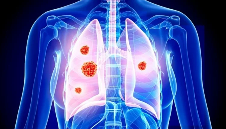 MSH për Ditën botërore të luftës kundër kancerit: Duhanpirja është faktori më i madh i rrezikut për kancerin e mushkërive